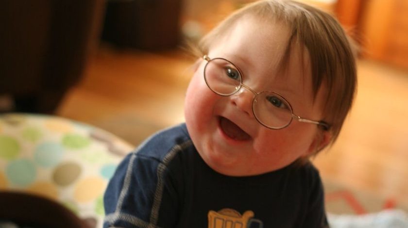 Σύνδρομο down